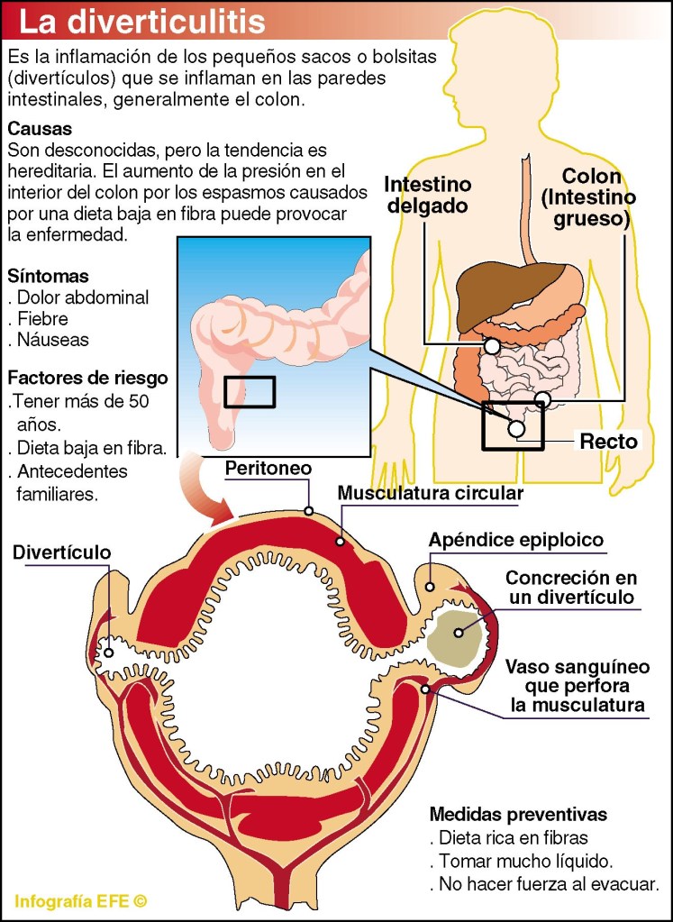 Infografía sobre la diverticulitis. EFE/ Omar Goncebat