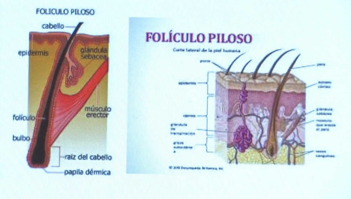 foliculitis