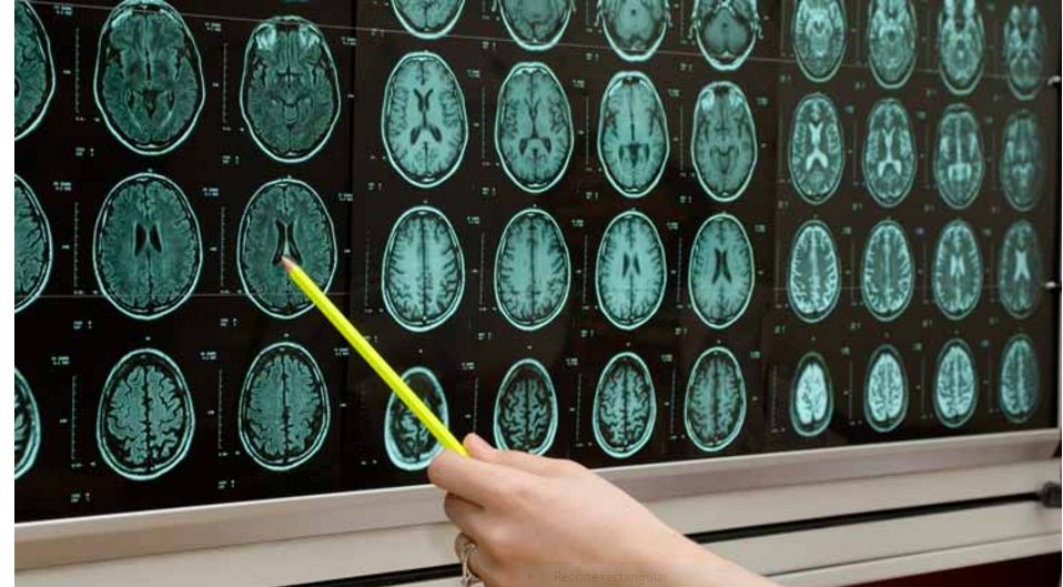 esclerosis múltiple 50 años