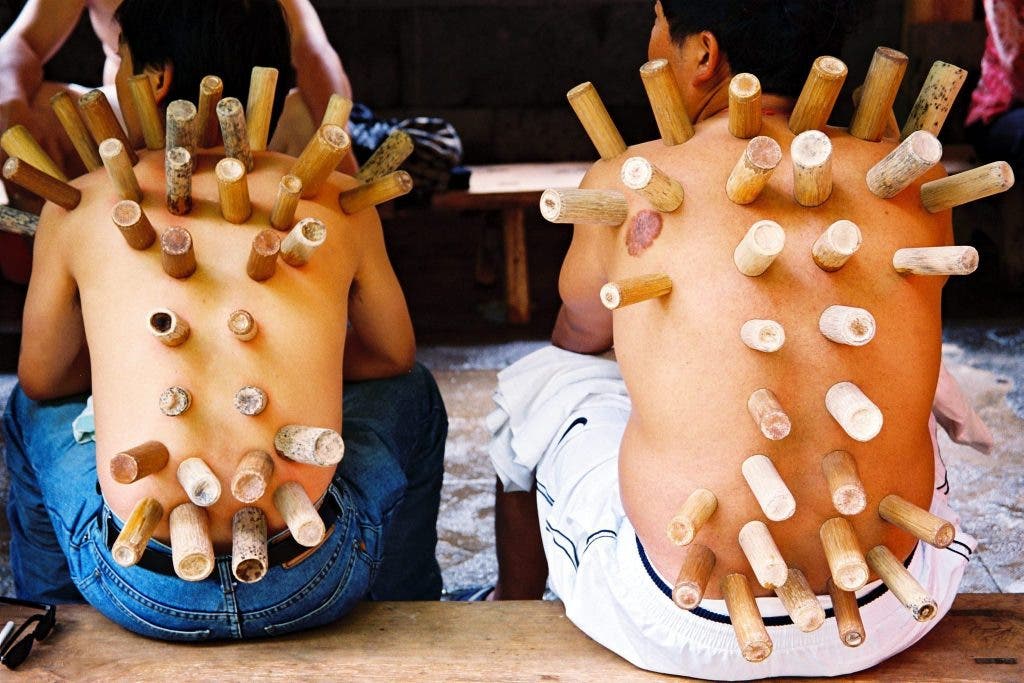 Terapia con ventosas (cupping)