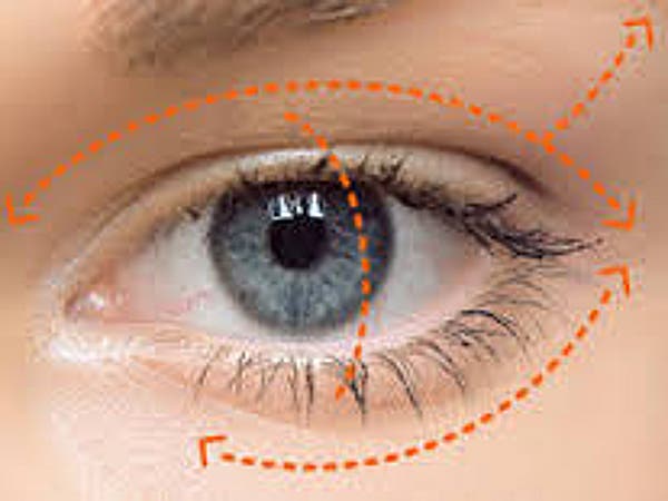 Párpados y ojos antes y después de una cirugía de blefaroplastia.