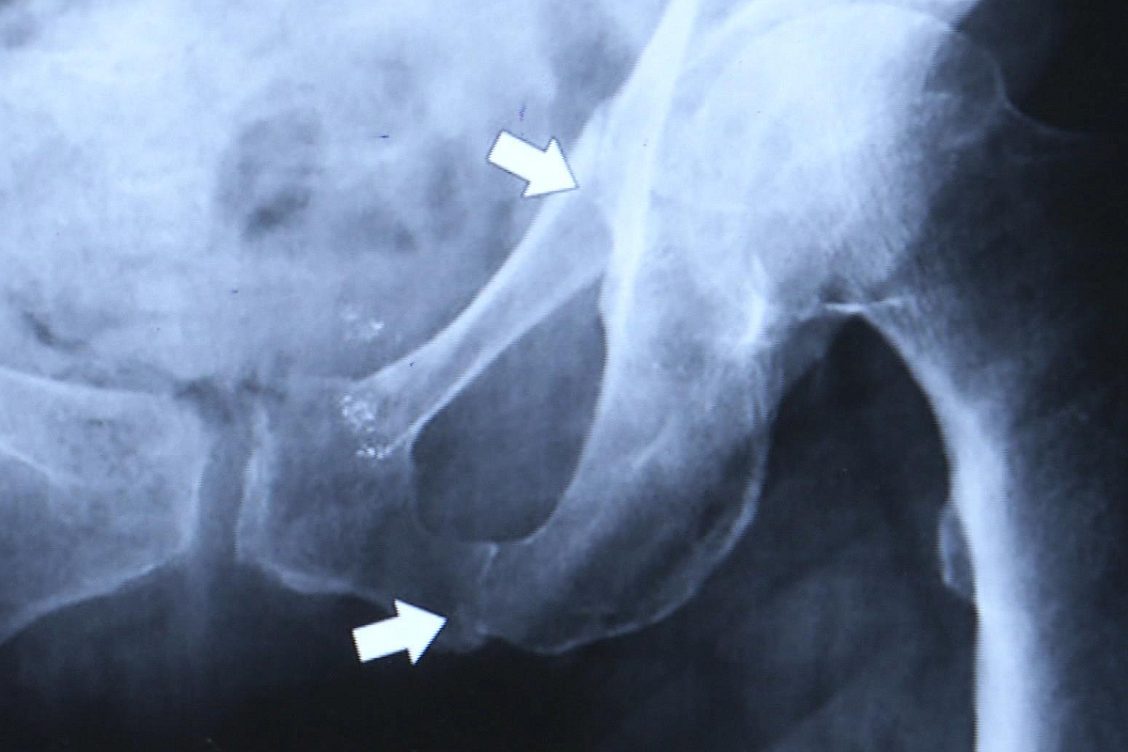 RX de fisura en ramas pubianas