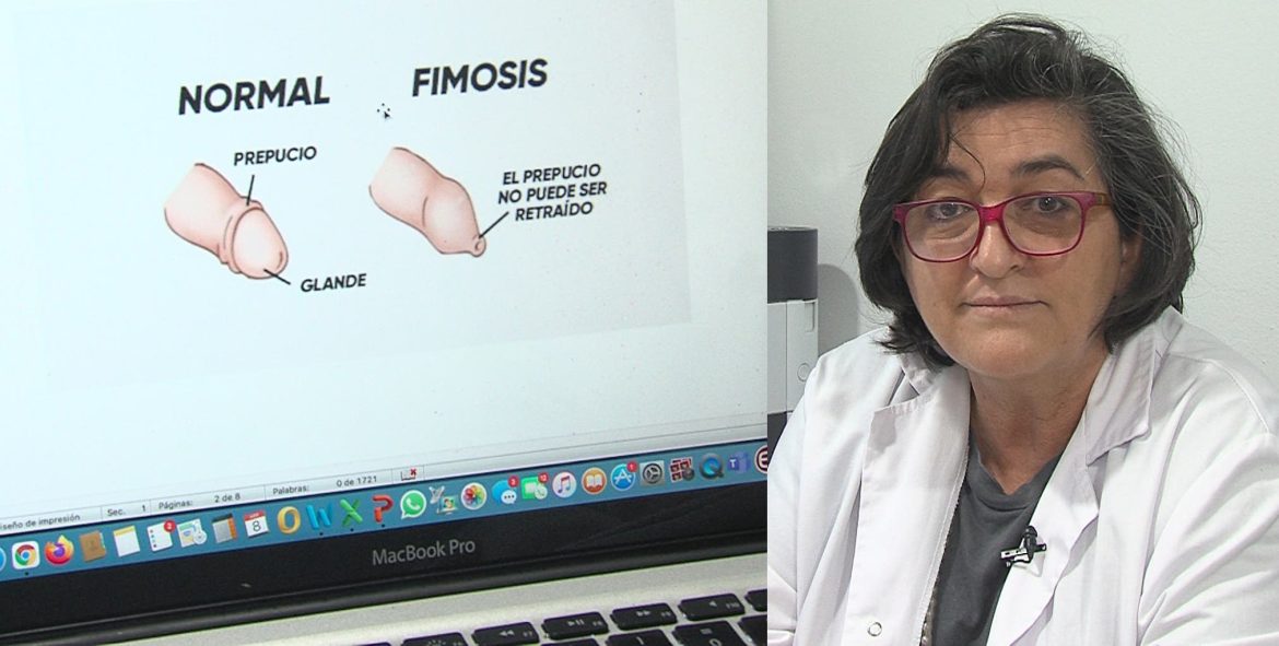 Encuesta fimosis, glande y prepucio-efe