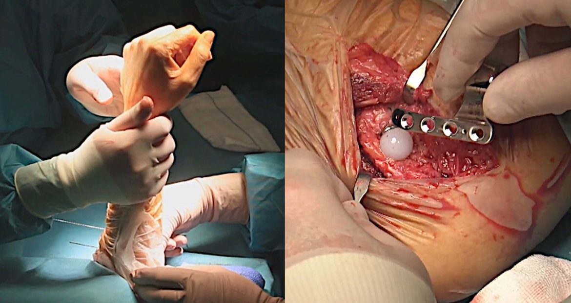 Antebrazo y mano en una operación de codo en la articulación radiocubital-efe