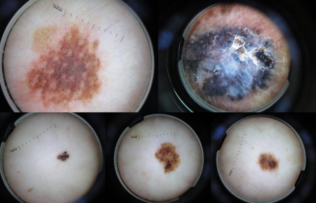 melanoma