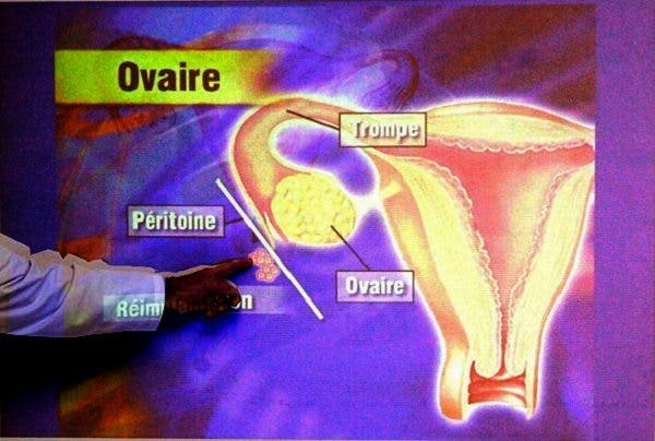 endometriosis cáncer ovario