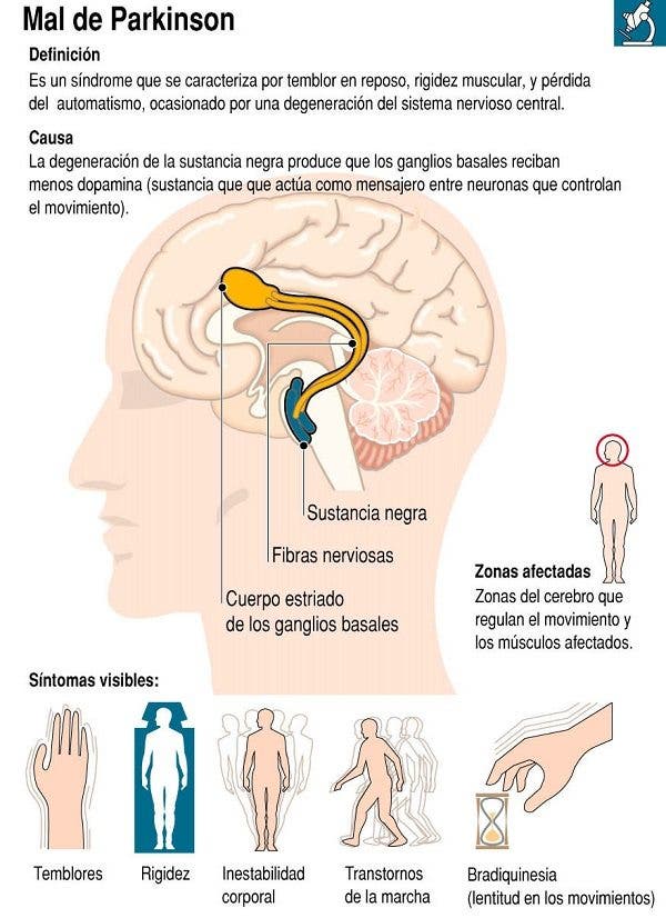 Infografía sobre la Enfermedad de Parkinson. Efesalud.com