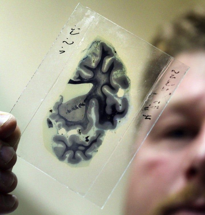 Una muestra microscópica de un cerebro humano en el laboratorio. EFE/BERND WUESTNECK