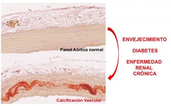 calcio arterias