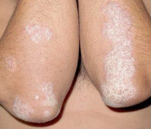 psoriasis vida sexual