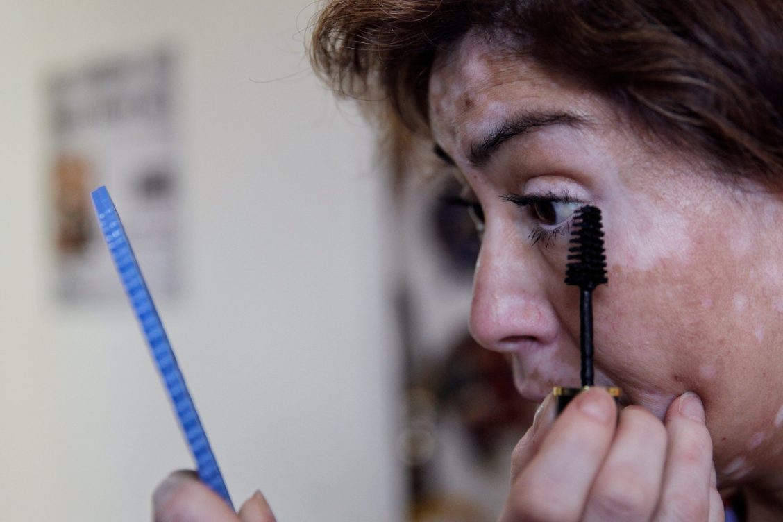 psoriasis vida sexual