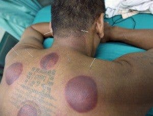 Morados que provocan el cupping. EPA/RUNGROJ YONGRIT