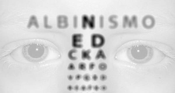 albinismo