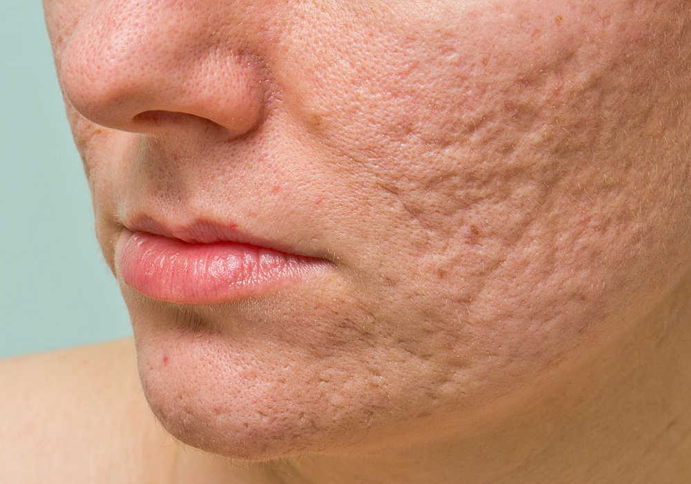Rostro femenino con acné profundo.