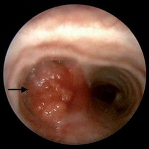 Fibrobroncoscopía para analizar un cáncer de pulmón