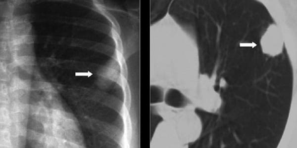 TAC para confirmar un cáncer