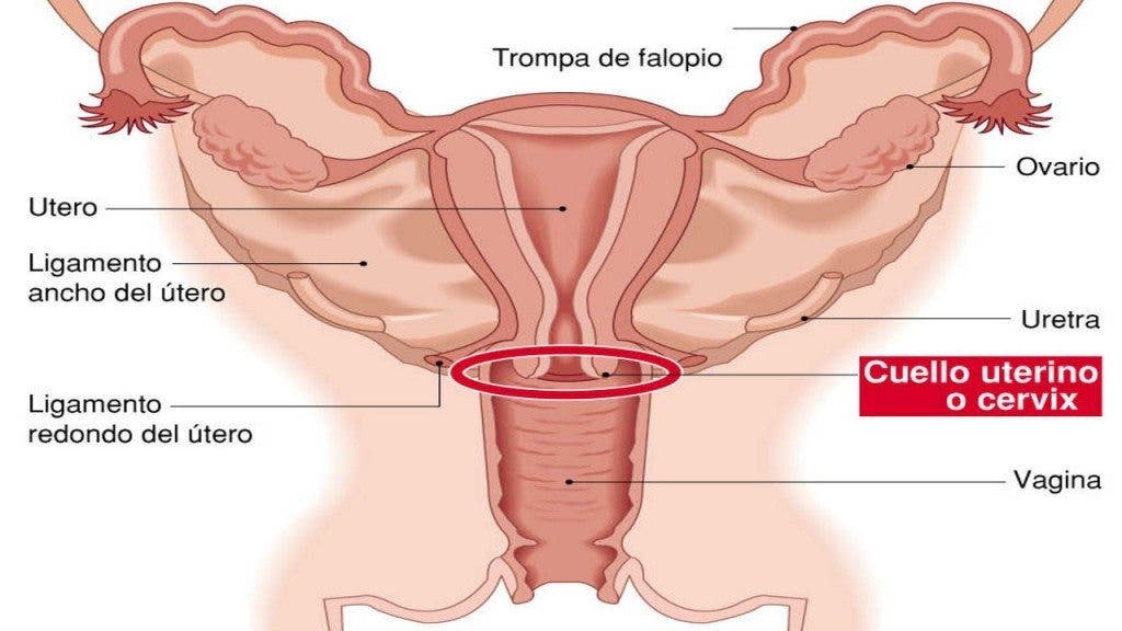 Dibujo del aparato reproductor femenino (vagina, útero, trompas de falopio y ovarios, donde se señala en rojo, al final de la vagina, el cáncer de cuello de útero o cérvix-efe