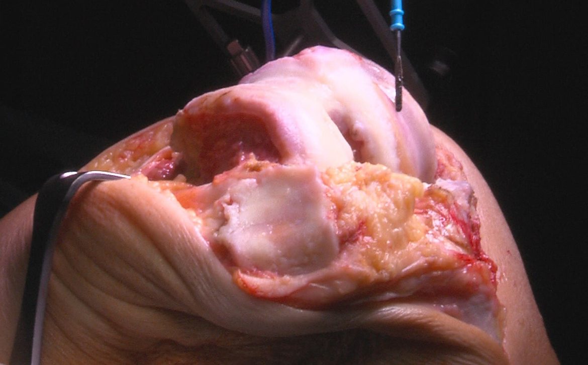 Artrosis de rodilla-efe