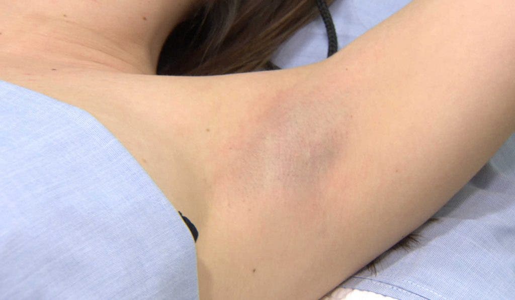 Axila de una joven preparada para la depilación láser-efe