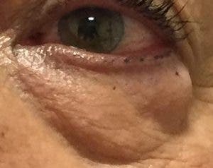 Bolsa palpebral en el ojo izquierdo.