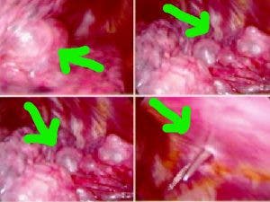 Imagen de la superficie pulmonar vista a través de videotoracoscopia de una paciente con LAM donde se aprecian múlitples quistes o bullas pulmonares.