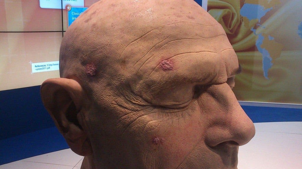 Psoriasis