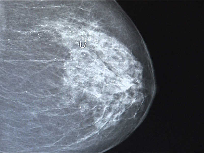 Fotografía de una radiografía de una mama con cáncer.
