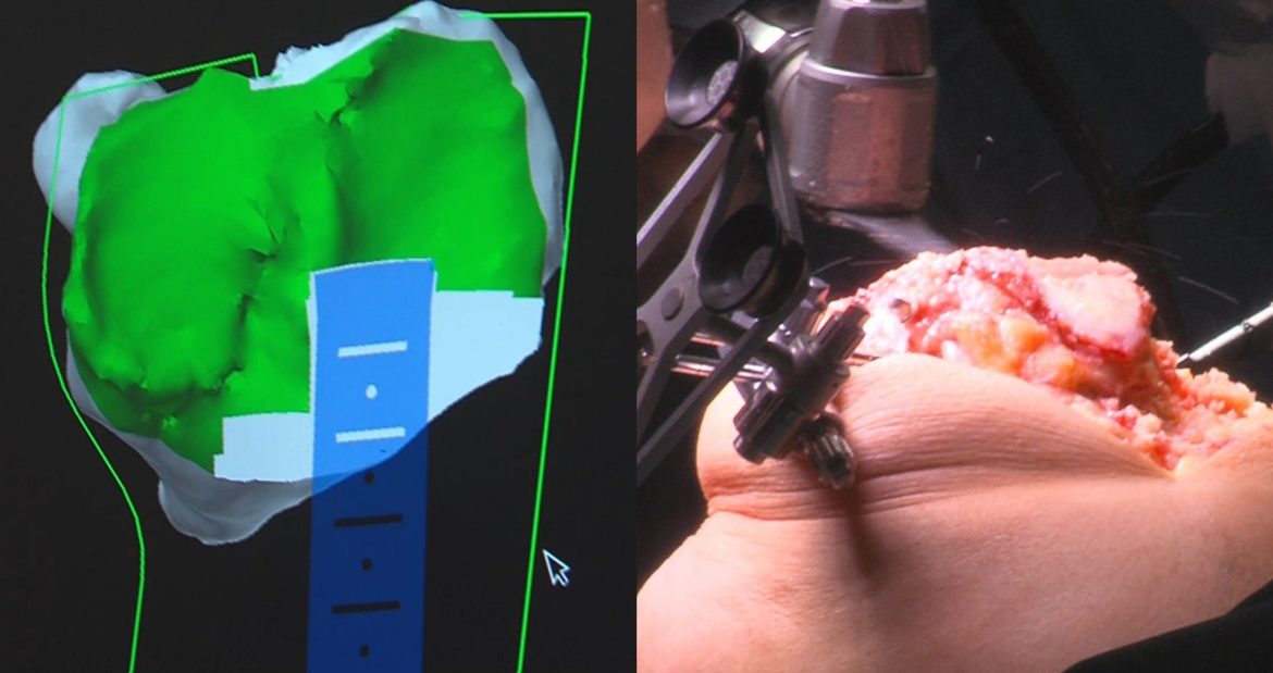 Corte del extremo tibial con Mako