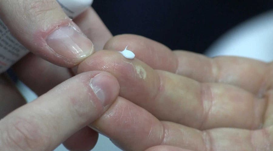 El tratamiento de cáncer provoca efectos en la piel como la sequedad y cuidar este aspecto se convierte en un reto.