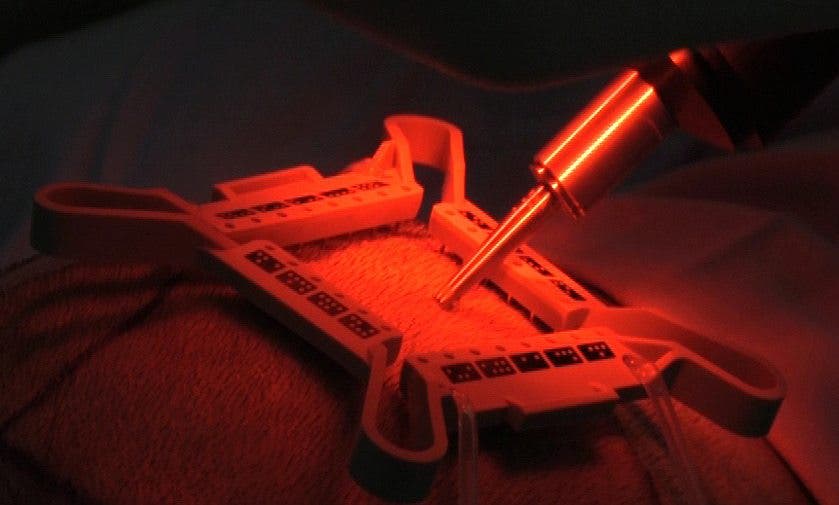 Detalle de la aguja computerizada de Artas, con la que el robot extrae los folículos capilares.
