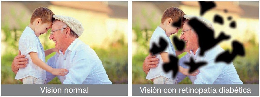 Diabetes-retinopatía-ojo