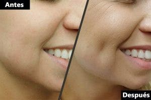 Dimpleplastia