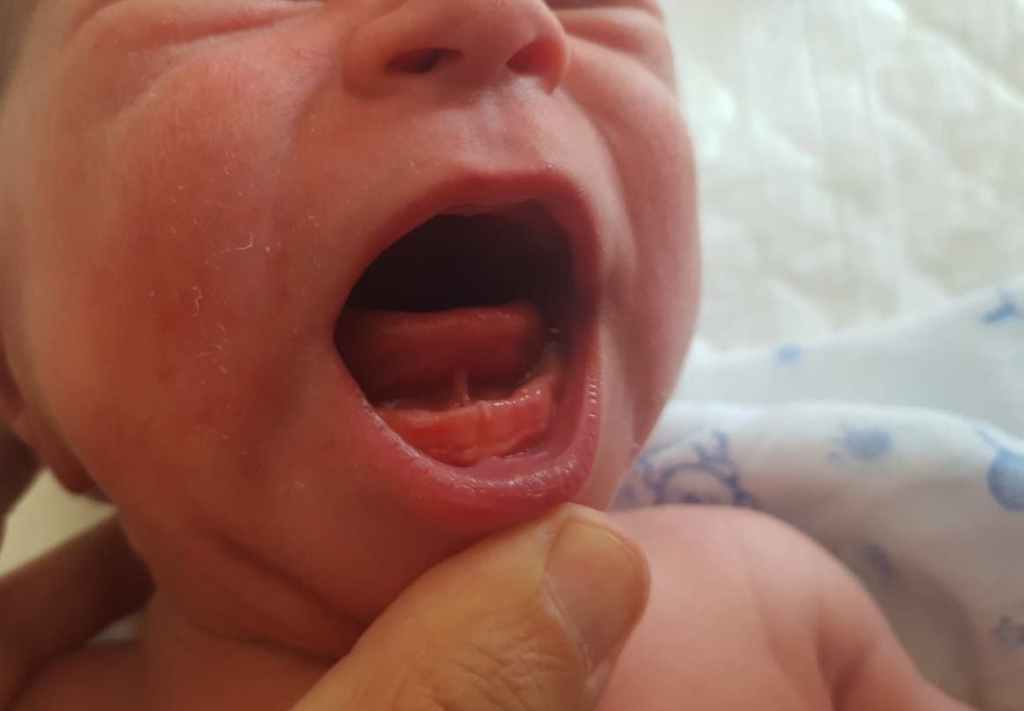 frenillo sublingual bebé