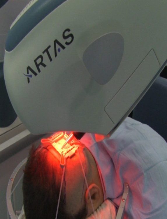 El robot Artas funciona a través de un brazo mecánico que desplaza con exactitud milimétrica su cabeza extractora