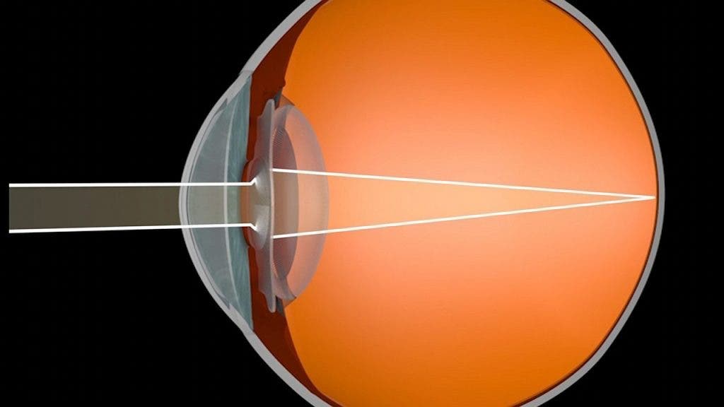 lente intraocular fáquica
