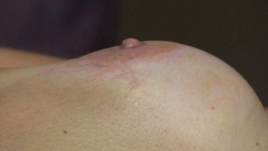Evolución de la areola y el pezón de la mama izquierda durante el tatuaje paramédico. Nadie diría que la areola y el pezón forman parte de una reconstrucción. efesalud.com