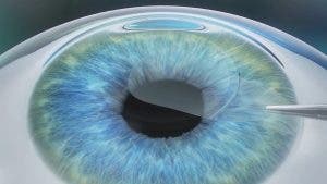 Simulación de extracción de lámina corneal con técnica Smile
