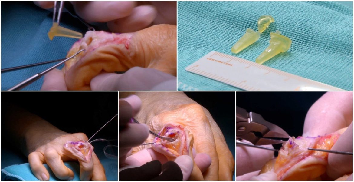 Extracción silicona y preparación zona tratada en la articulación