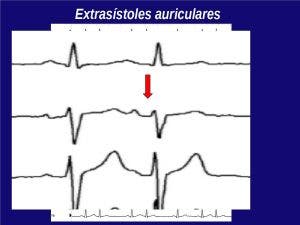 Taquicardias del corazón. Extrasístole auricular,ventricular