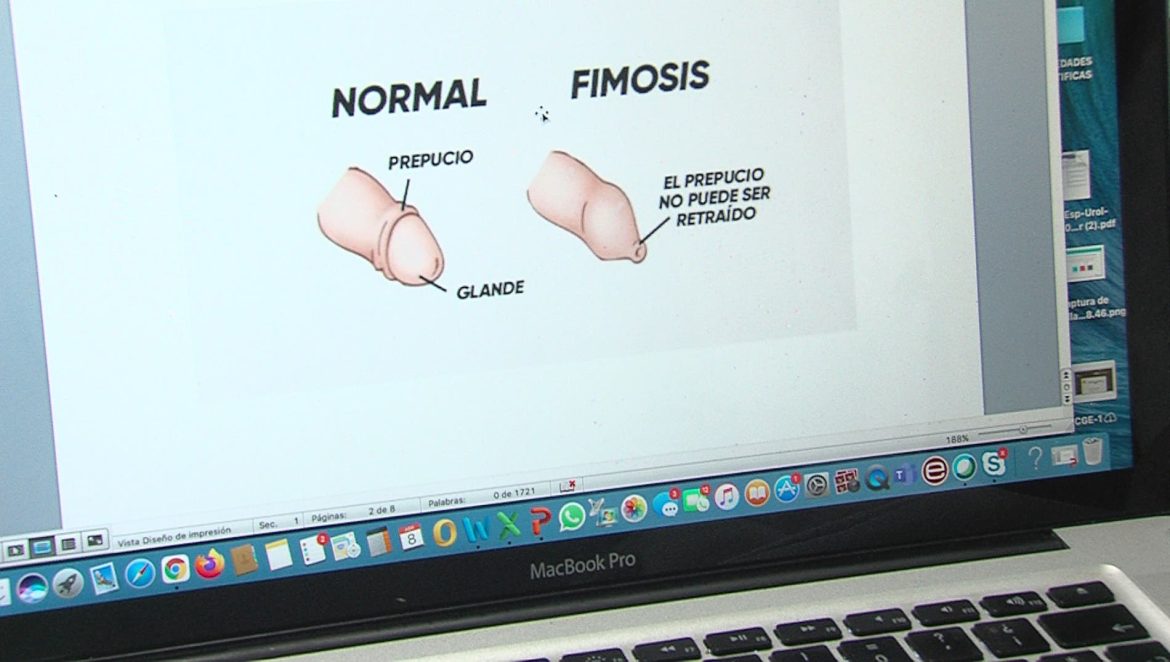 Dibujo de un pene normal y otro con fimosis.