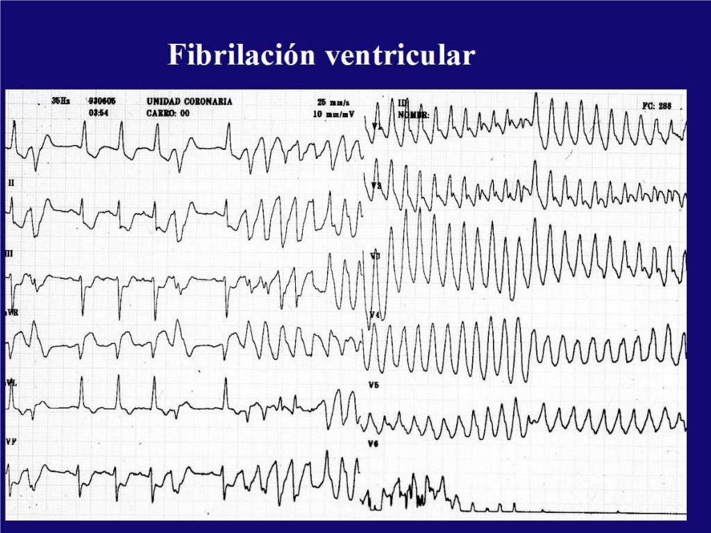 Taquicardias del corazón. Fibrilación ventricular