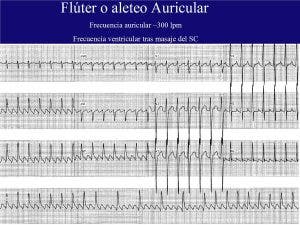 Taquicardias del corazón. Aleteo o Fluter