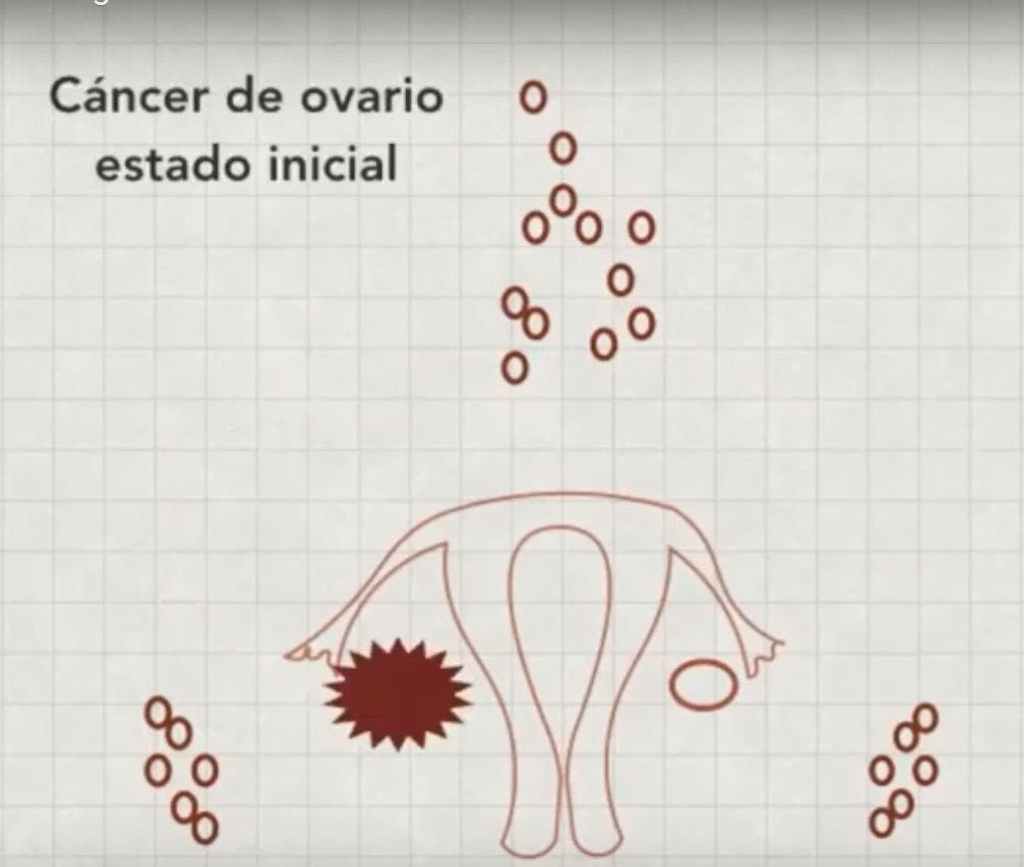 ganglio centinela en ovario