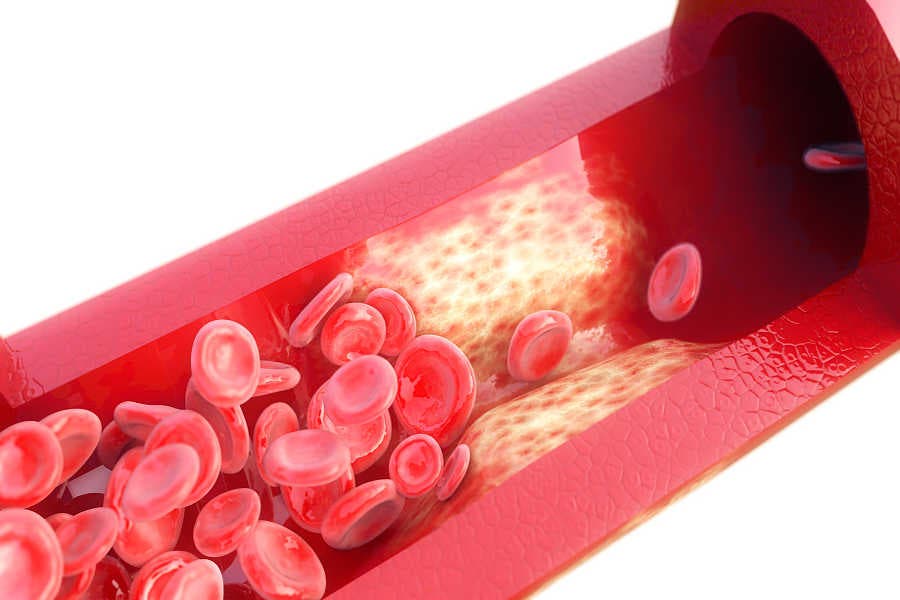 Una vena o arteria engrosada con colesterol impide el sexo sano