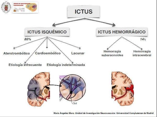 ictus