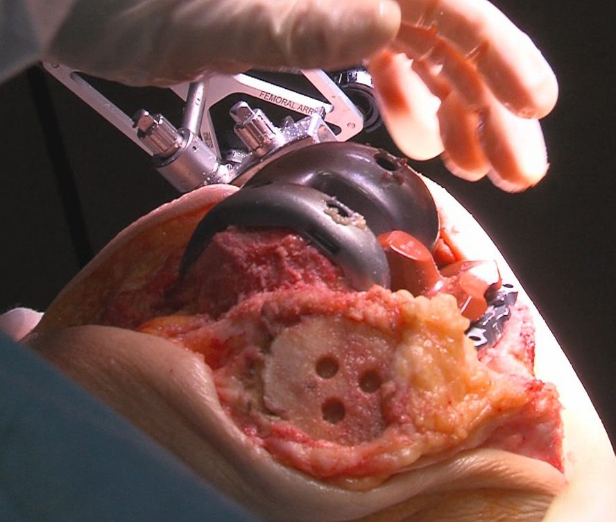 Implantes de rodilla de prueba-efe