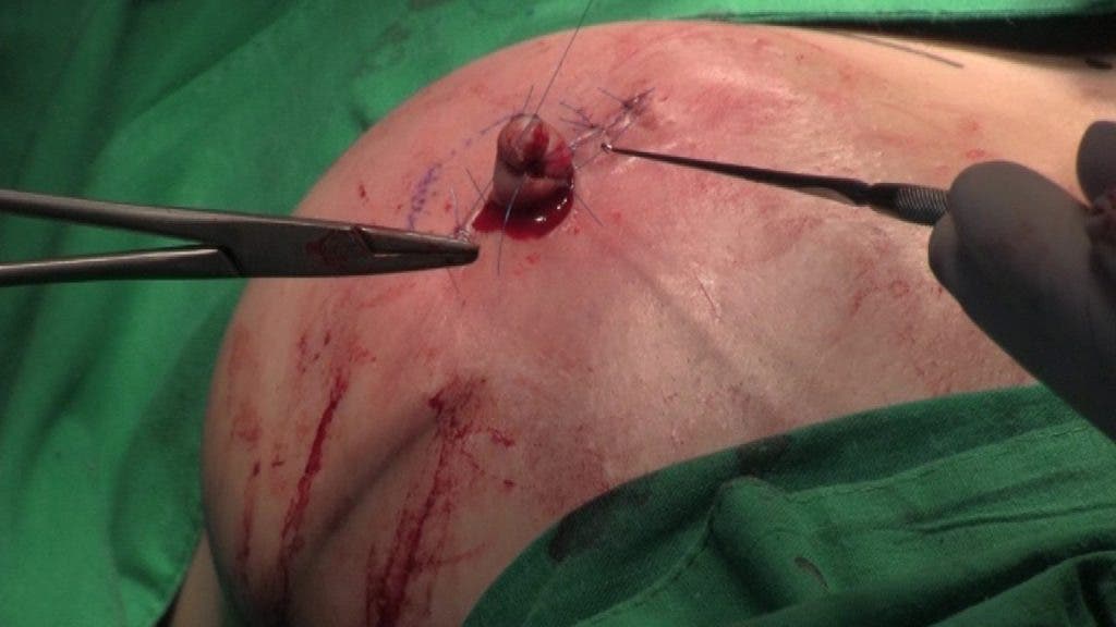 Las cirujanas aplican los últimos puntos de sutura sobre el nuevo pezón de Beatriz. efesalud.com
