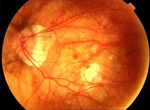 Zona retiniana del globo ocular con miopía magna.