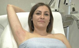 Macarena antes de recibir un tratamiento para remediar su hiperhidrosis axilar-efe