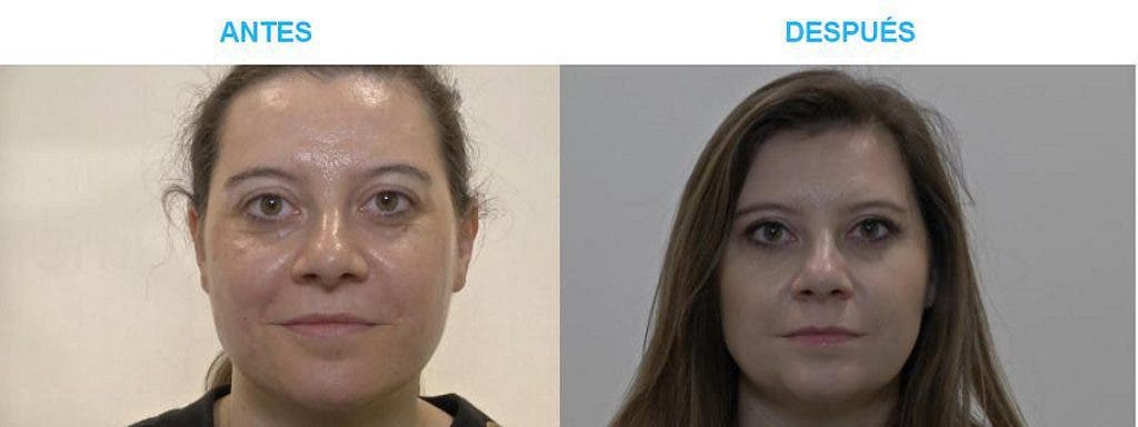 Mayte, antes y después del tratamiento de rejuvenecimiento facial.